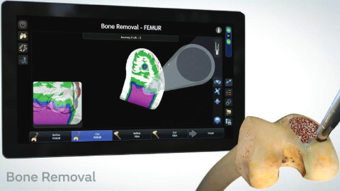 CORI Robotic Assisted Technique CORI Robotic Assisted Technique