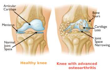 Knee with Osteoarthritis Knee with Osteoarthritis