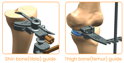 Partial Knee Replacement with Traditional Techniques Partial Knee Replacement with Traditional Techniques
