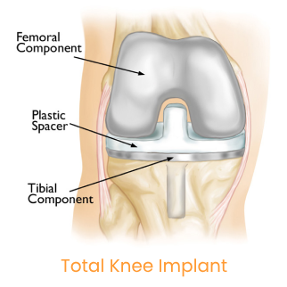 Total Knee Implant Total Knee Implant
