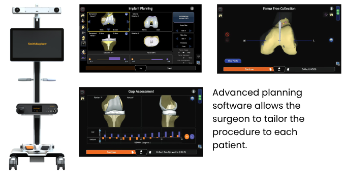 Total Knee Replacement with CORI Surgical System Total Knee Replacement with CORI Surgical System